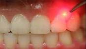 closeup of laser work being done on teeth